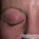 Eye allergies due to cosmetics